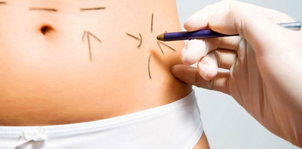 جراحی لیپوماتیک