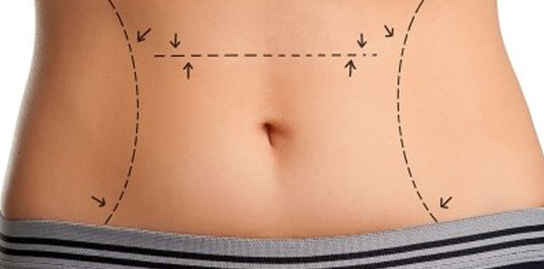 ابدومینوپلاستی