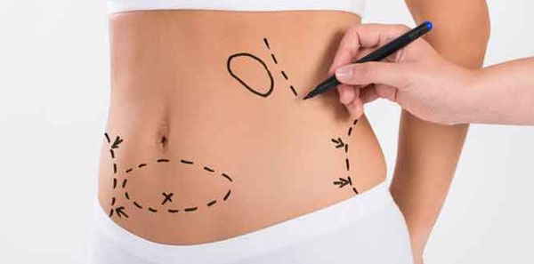 ابدومینوپلاستی