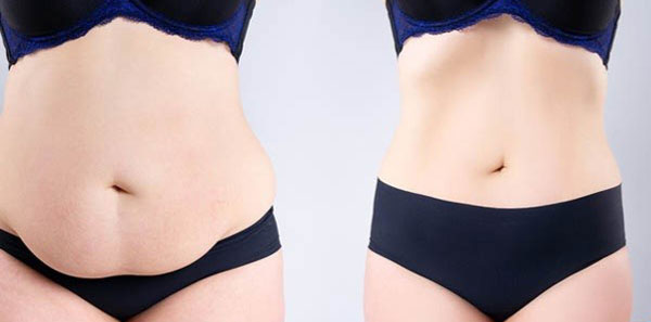 ابدومینوپلاستی