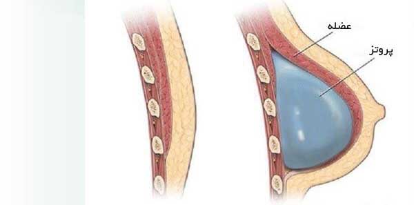 پروتز سینه