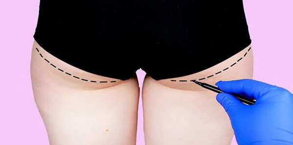 جراحی زیبایی باسن