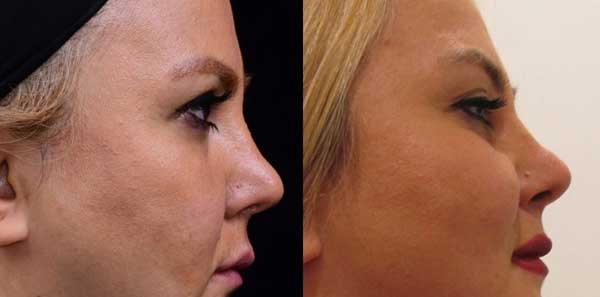 لایه برداری