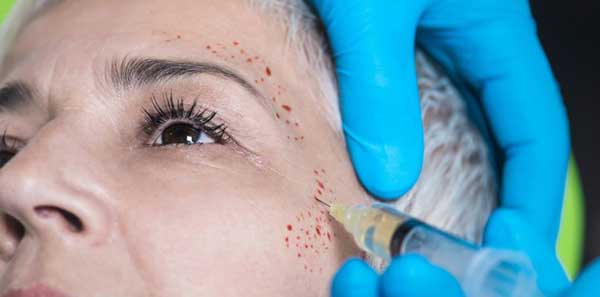 مزایای تزریق پی آر پی