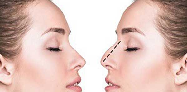 رینوپلاستی